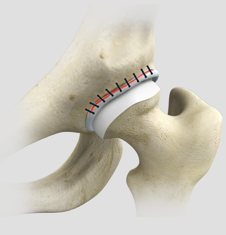 Hip Reconstruction